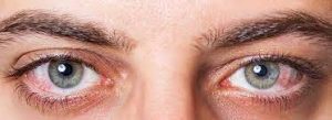Hội chứng khô mắt sau khi phẫu thuật đục thủy tinh thể (phaco)