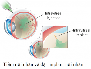 Triamcinolon acetonide – Tác dụng phụ nghiêm trọng trên mắt do tiêm vào dịch kính