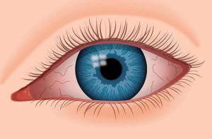 Khô mắt sau phẫu thuật Lasik